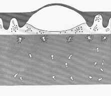 subepidermalvesicle.jpg (12332 oCg)